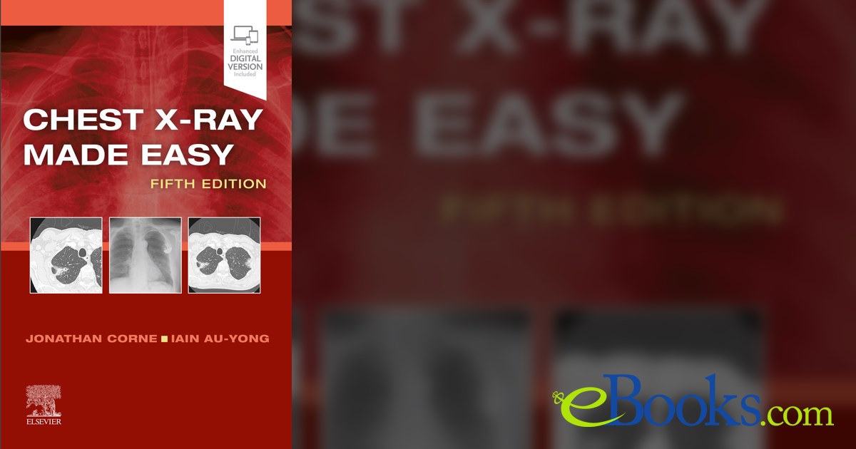 Chest XRay Made Easy (5th ed.) by Jonathan Corne (ebook)